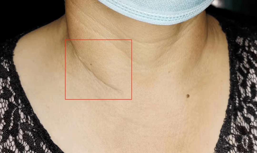 正常的甲状腺脖子图片图片