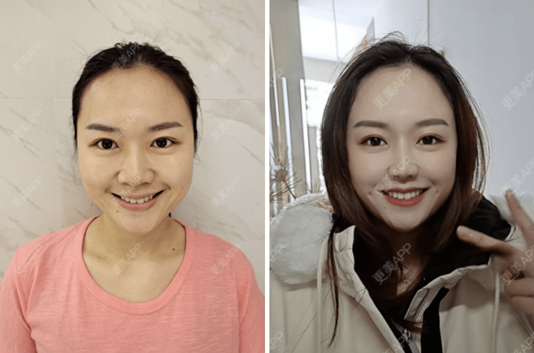 梨涡对面部优化效果竟然那么大!_笑容