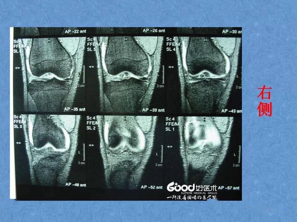 70张膝关节mri高清解剖图解 推荐收藏