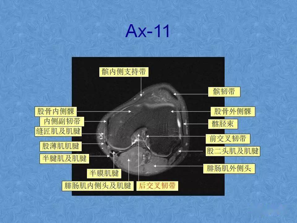 70張膝關節mri高清解剖圖解推薦收藏