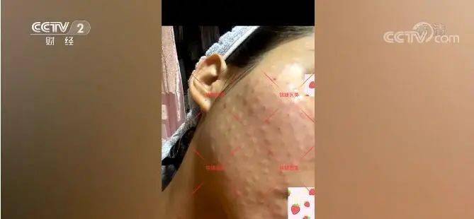 央视曝每3支水光针就有2支是假货市场上假货水货横行