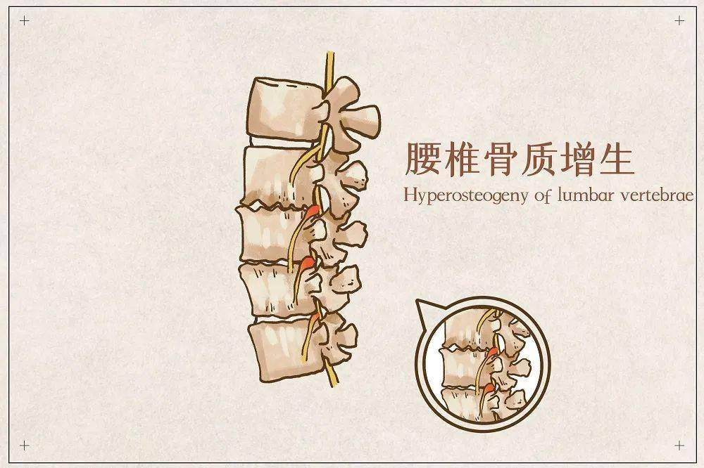 骨质增生能补钙吗?真相是