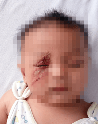 脸上有东西!妈妈拍了一下,3岁女儿差点毁容!_虫子