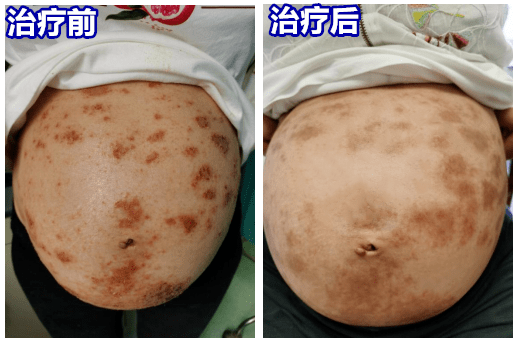 【玉颜阁】孕妇湿疹,中药外洗有奇效