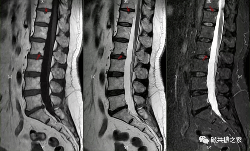 长t,长t2信号,见髓核信号突入椎体内,常伴椎间隙变窄,常见于l3~s1椎体