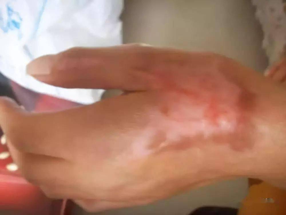 轻度烧伤涂点蜂蜜