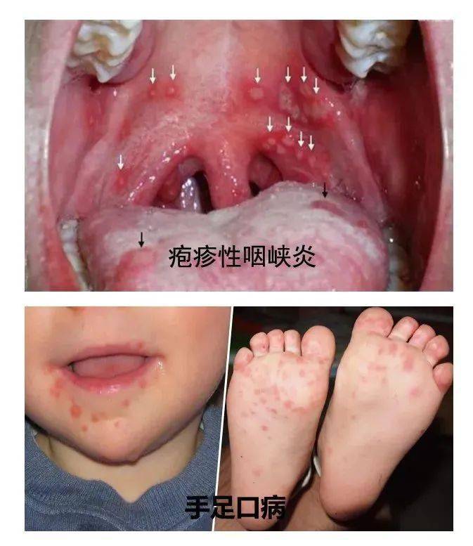 小孩手足口病喉咙图片图片