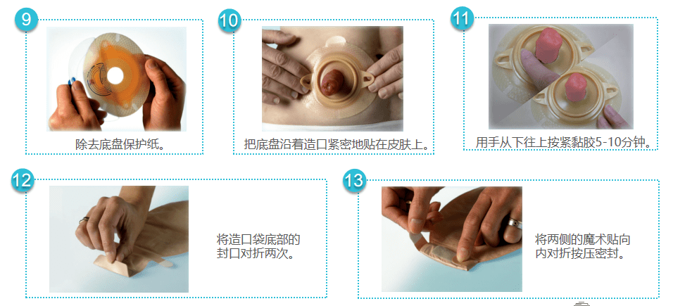 造口换药图片