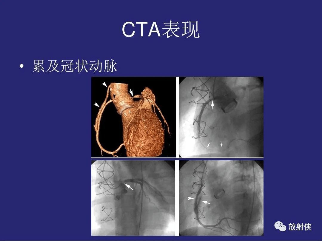 精品大动脉炎分型及ct诊断