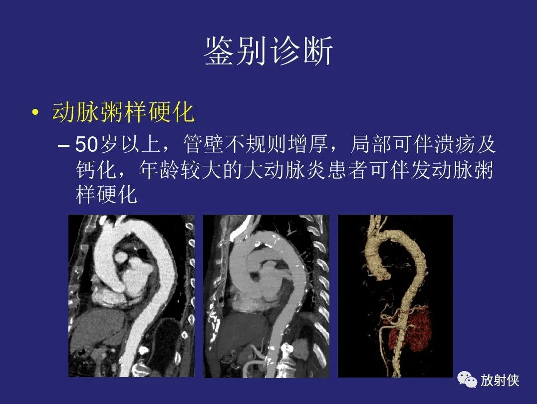 精品大动脉炎分型及ct诊断