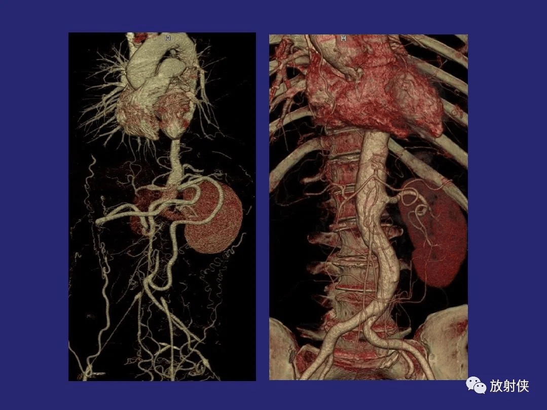 精品大动脉炎分型及ct诊断