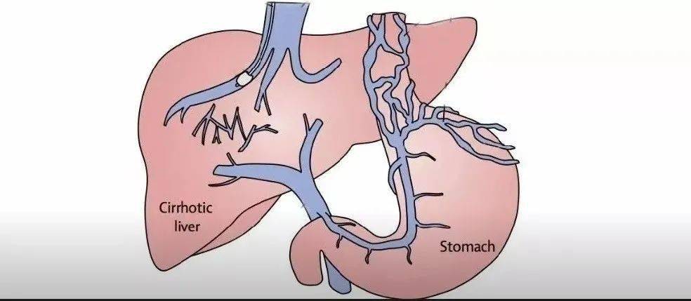 消化道大出血怎麼辦樹蘭成立肝硬化門靜脈高壓多學科協作組
