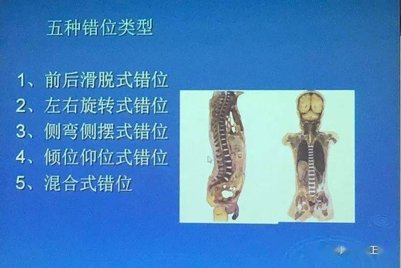 椎小關節錯位是脊椎病發作的主要原因