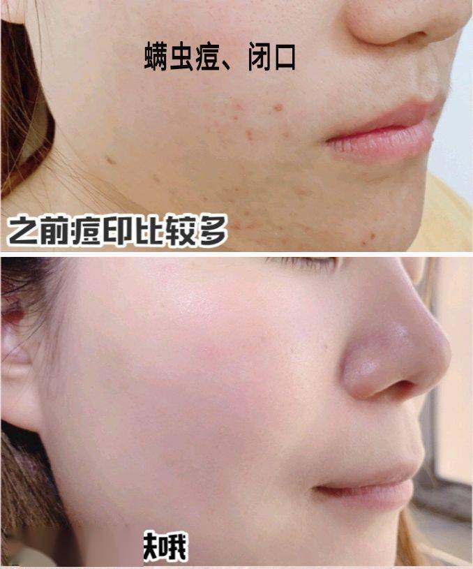 拒绝螨虫脸5秒揉一揉螨虫全出来了痘痘黑头全没了