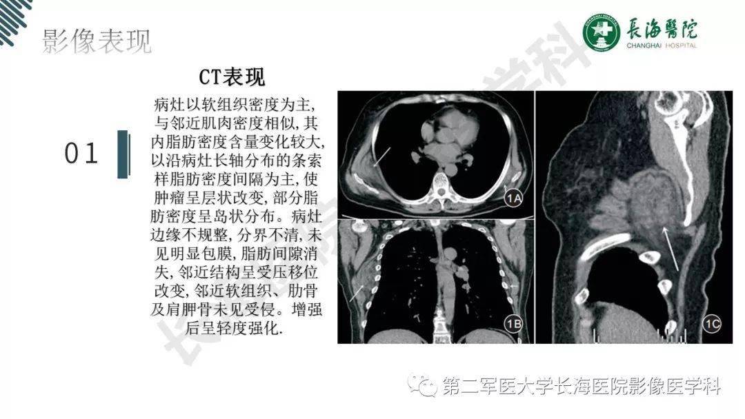 彈力纖維瘤的影像診斷