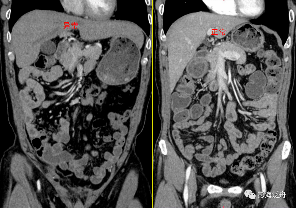 這個病,腹部ct經常會漏診!_解剖