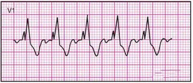 14种常见心电图波形的特点建议收藏