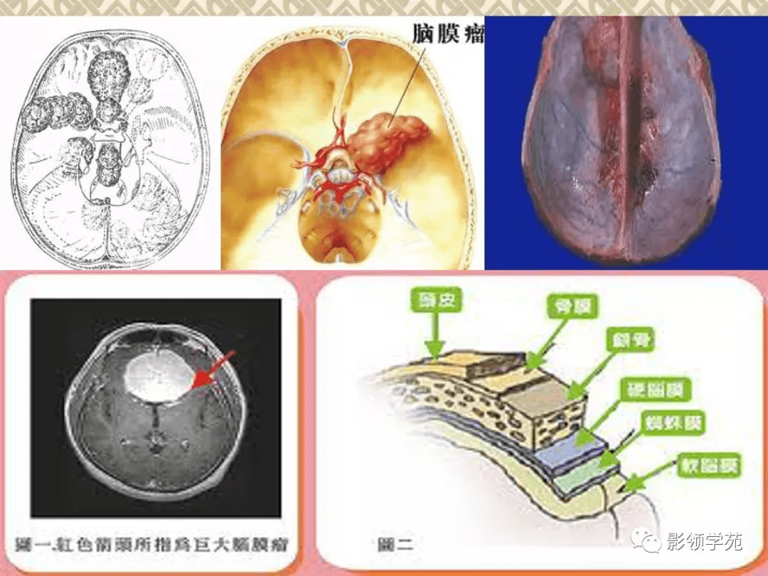 常見腦腫瘤的影像診斷