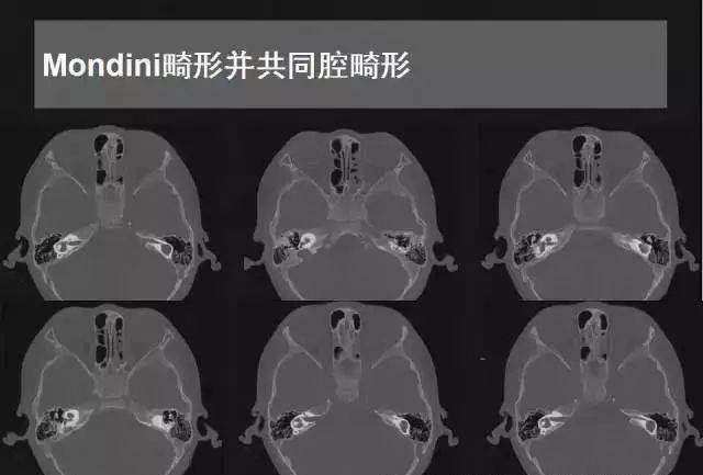 先天性内耳畸形影像学诊断