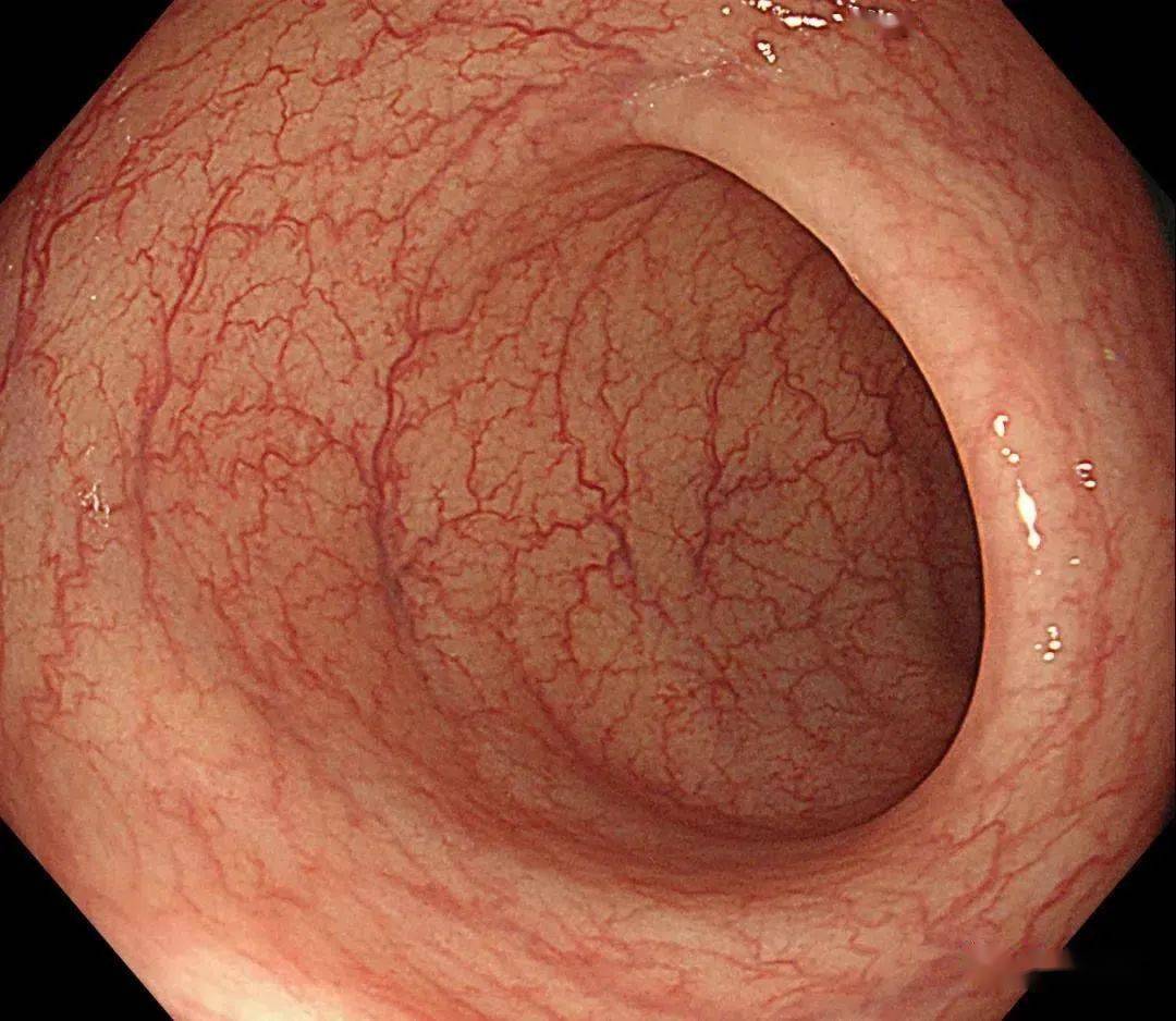 正常肠镜图片图片