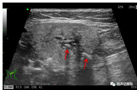 颌下腺导管结石的超声诊断