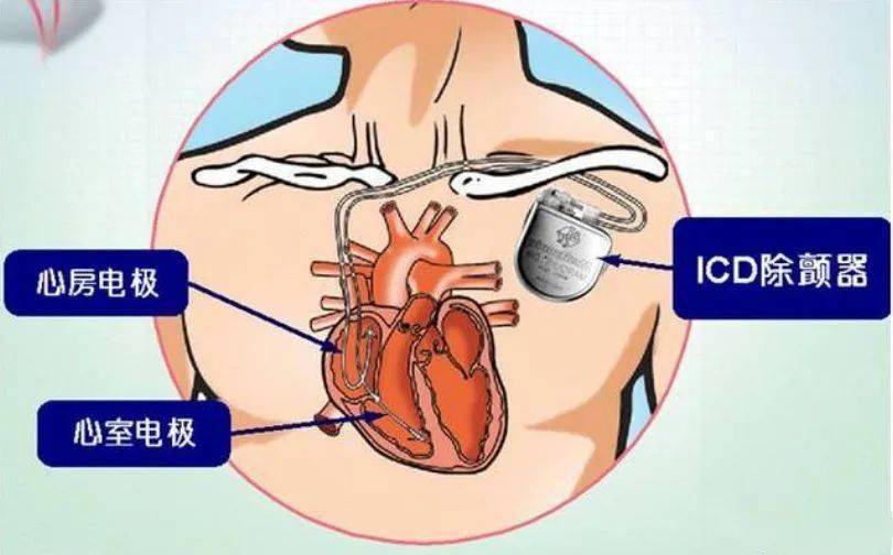 健康科普足球运动员比赛途中心脏骤停怎么办科学急救一定要学会这三步