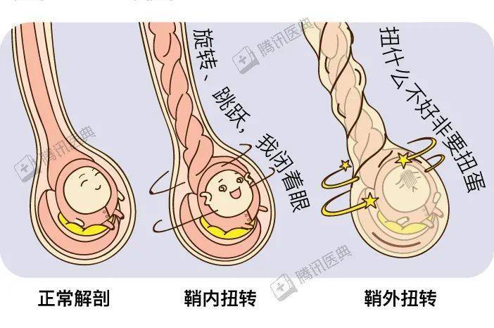 睾丸扭转示意图图片