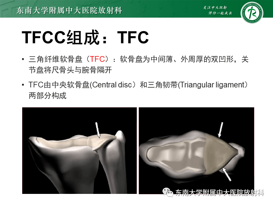 tfcc解剖及创伤性损伤