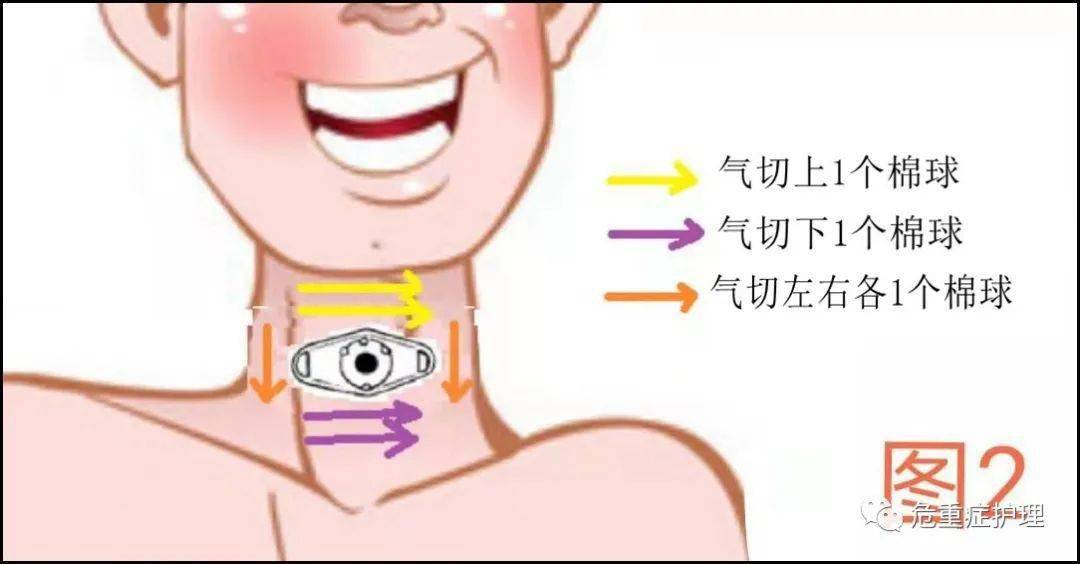 图文并茂:气管切开患者这样换药!_消毒