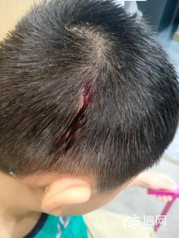 小朋友摔跤受伤的照片图片