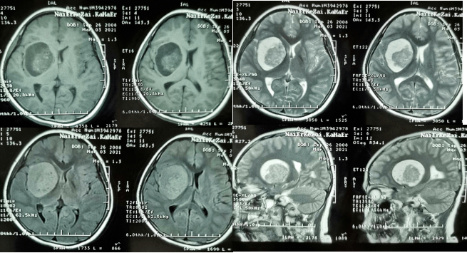 基底节MR图片