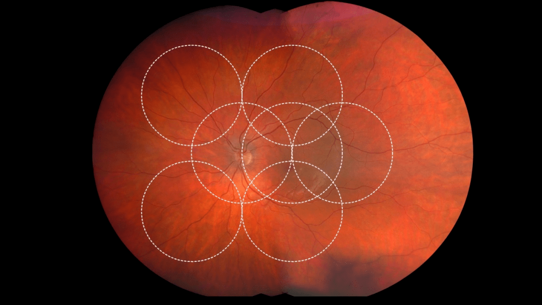 除了观察视野更广,超广角眼底照相机另一大优点在于无需散瞳即可检查