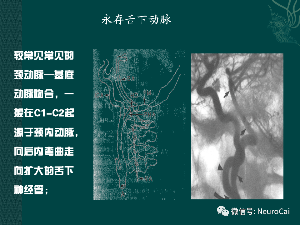 高清图脑动脉解剖与ct重建