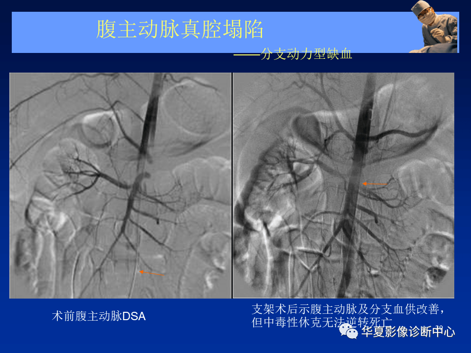 主動脈夾層,壁間血腫及穿通性潰瘍_診斷