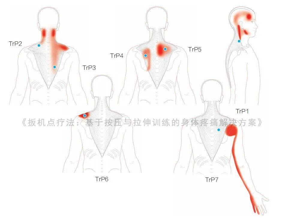 扳机点自助疗法缓解肩酸背痛立竿见影