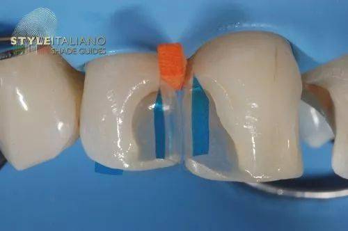 【牙医学堂】前牙直接修复时成形片的选择和放置