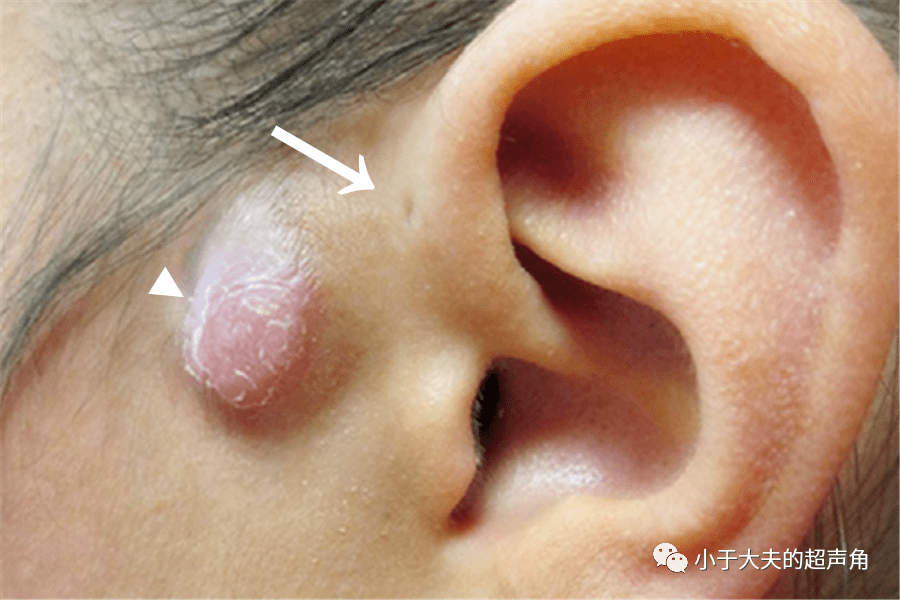 术后证实为先天性耳前瘘管(分泌型)