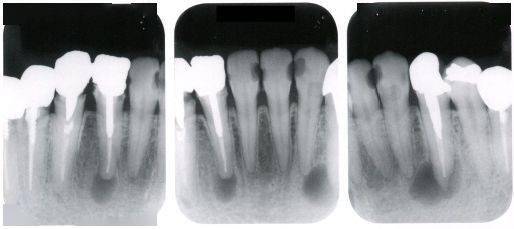 慢性根尖周炎牙片图片