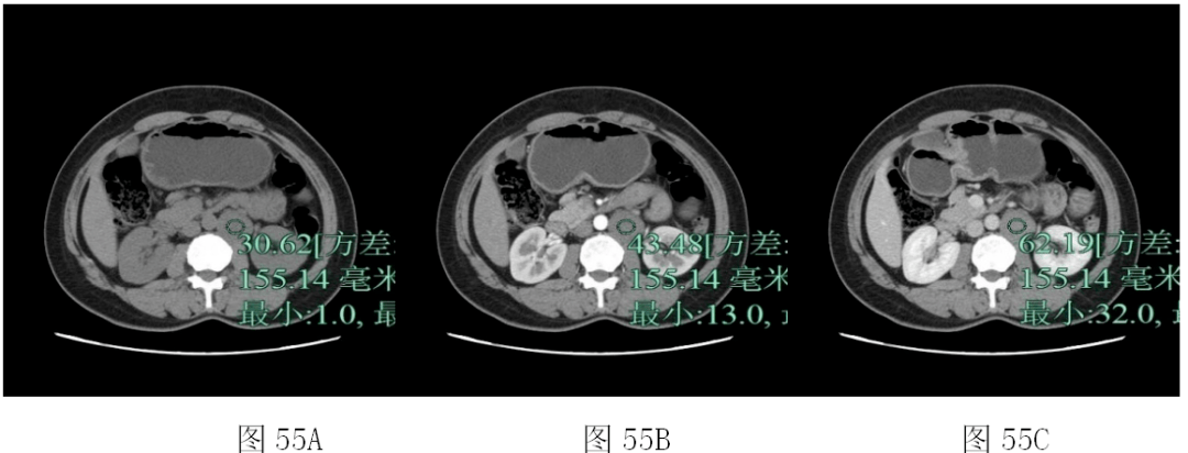 【spark病例挑战7.2】左肾下极占位性病变5天
