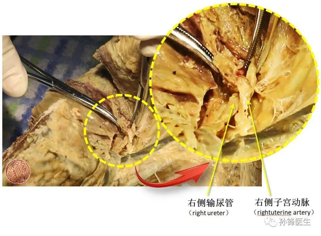 圖(14):右側子宮動脈與右側輸尿管的交叉↑↑↑女性輸尿管盆部與子宮