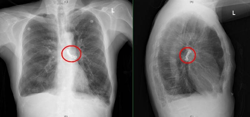 支气管|成排假牙掉进气道，肿瘤堵塞支气管……支气管镜开路悉数疏浚