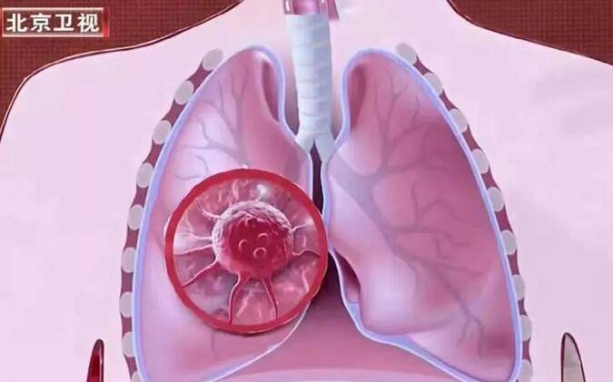风险|肺最怕“5种气”、“1类菌”，尽早避开！