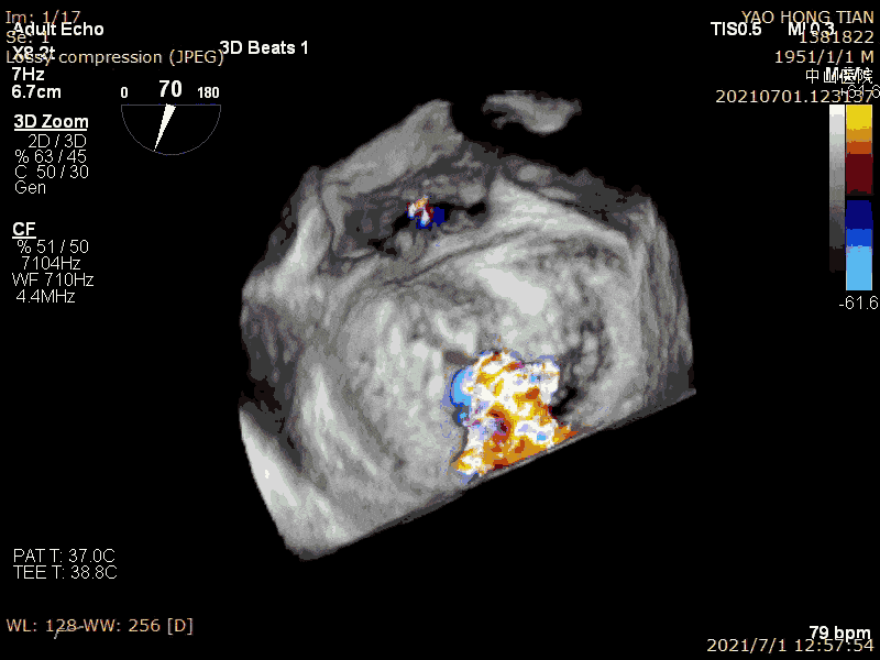 术前超声诊断:左心室射血分数 lvef 58%,左心室舒张末内径lvdd 52mm