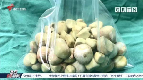 严重|七旬老伯膀胱内取出103颗结石，最大直径近2厘米