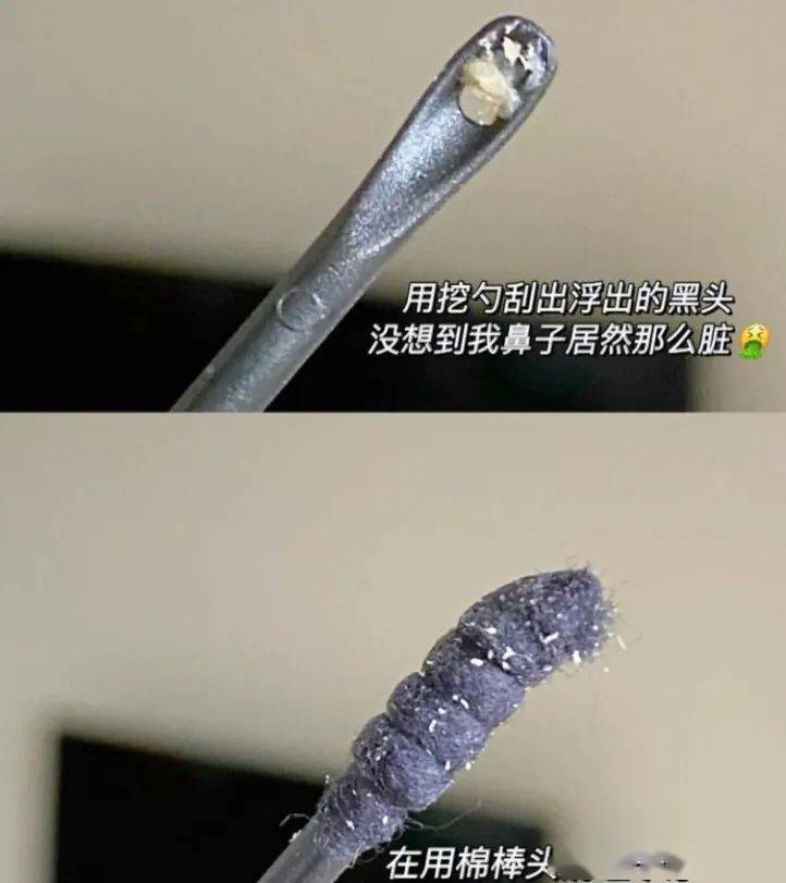 黑头|挤黑头＝作死！这样去黑头才是王道！