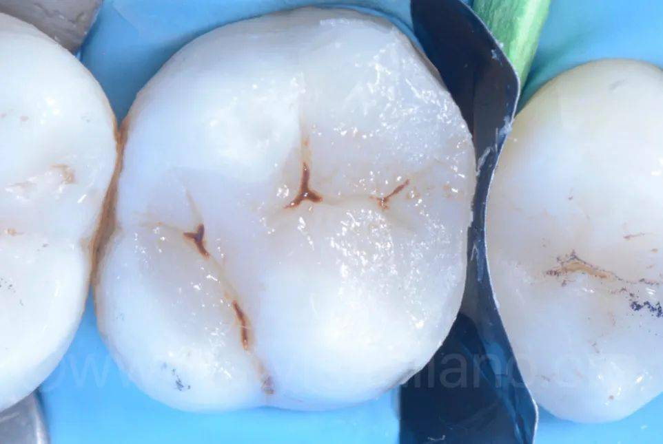 如果邻牙存在窝沟染色,可以在窝沟添加染料模拟.图28.