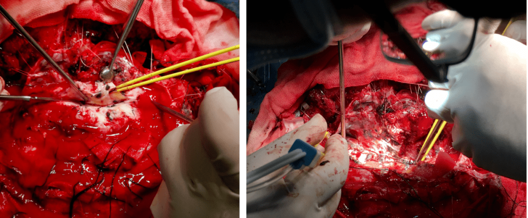 【内外兼修】徐斌教授团队:复合手术治疗颅内巨大血管外皮瘤一例_肿瘤