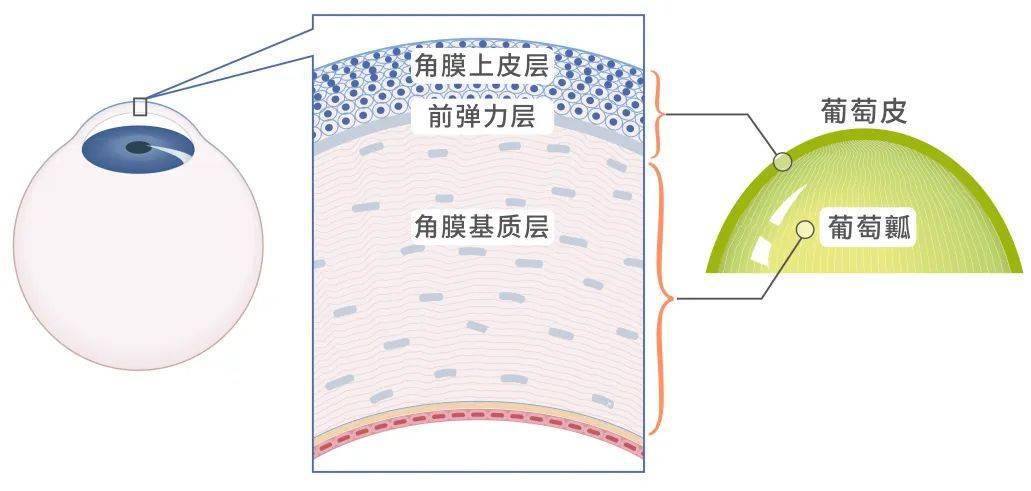 角膜分为五层,跟手术相关的主要是表面的「上皮层「前弹力层」和