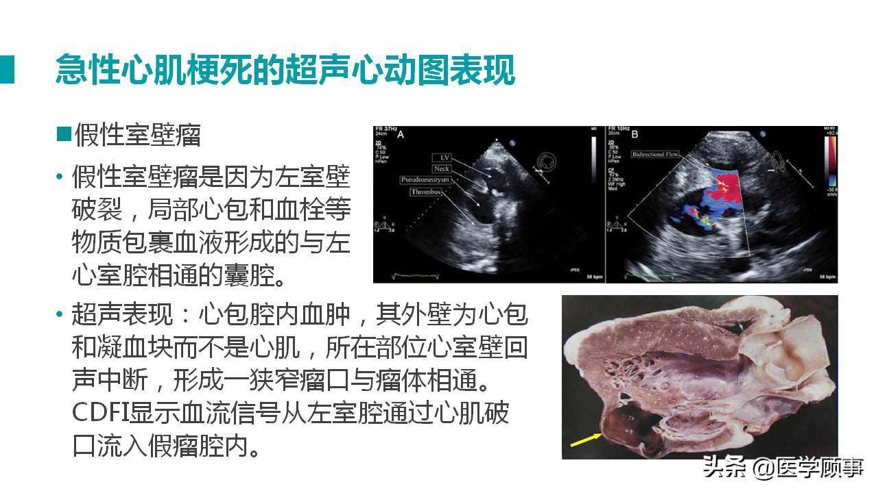 心肌梗死及其并发症的超声诊断