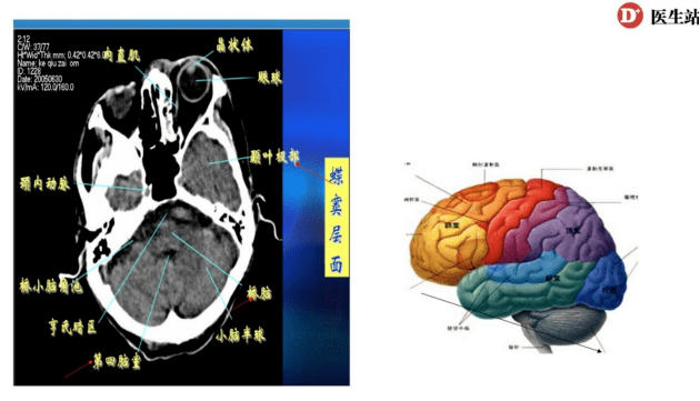 如何從腦部ct分辨不同病變